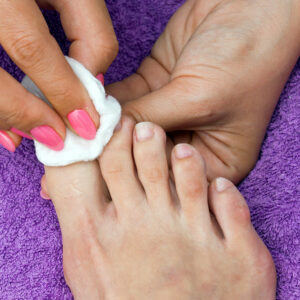 Toenail Fungus – Risk Factors and Treatment Options